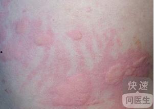 吃瓜过敏皮疹